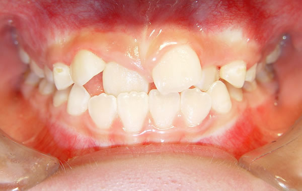 牙错位令牙齿特别难看,想笑又不敢笑,担心露出难看的牙齿,因此