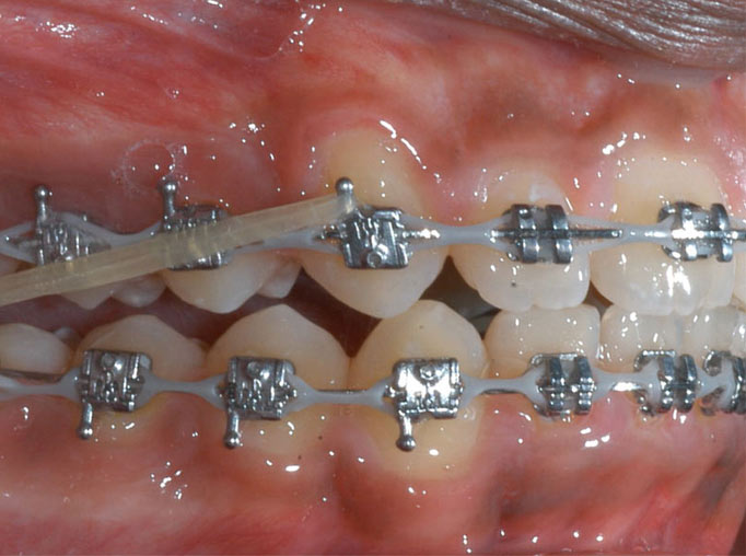 前牙开颌矫正效果怎么样?