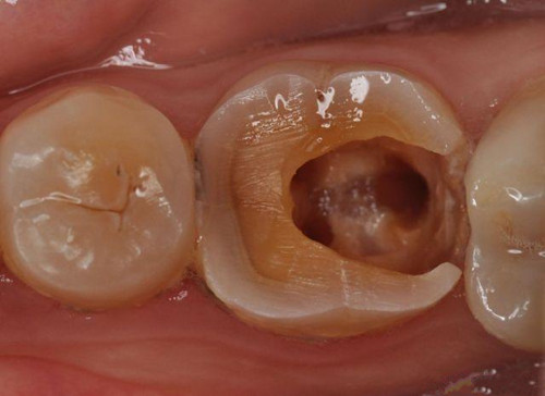 牙髓炎常发于夜间的原因