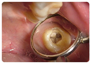 出现牙髓炎如何快速止痛?