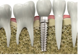 种植牙条件