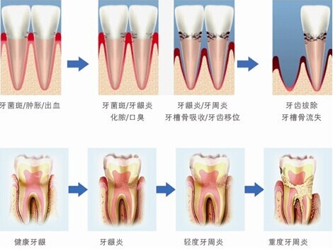 牙周病能治好吗