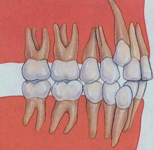 牙齿拥挤的原因有什么