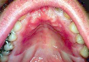 长期塞牙，隐藏口腔疾病