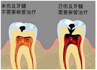 急性牙髓炎治疗