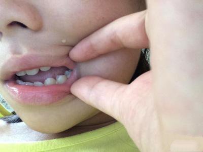 牙病治疗后的牙痛处理方法
