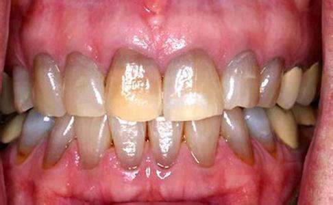 四环素牙的形成原因是什么呢
