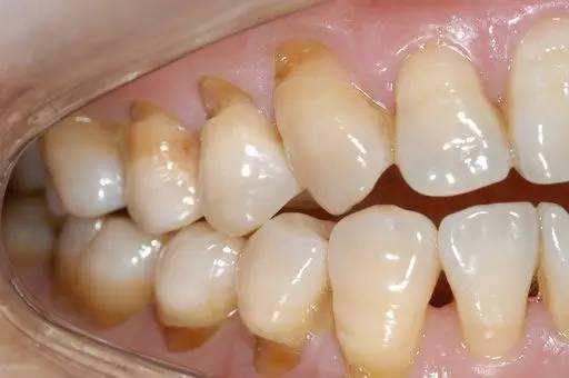 牙齿变色受什么因素影响