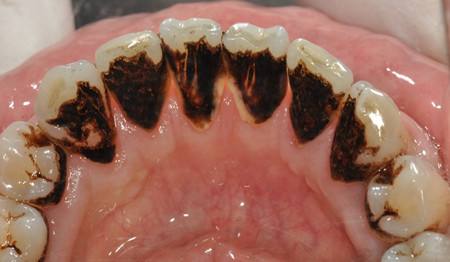 牙结石的形成过程及危害