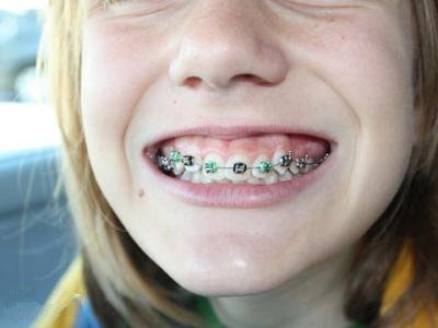 儿童牙齿矫正的合适年龄