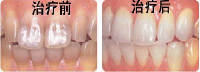 遗传性黄牙完全可以变白
