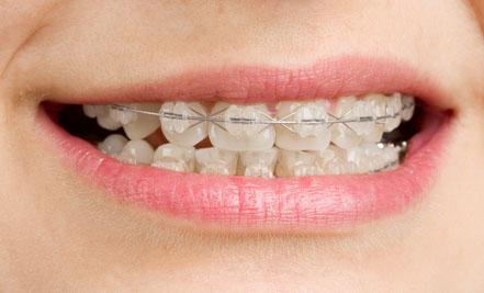 牙齿矫正期间的口腔卫生