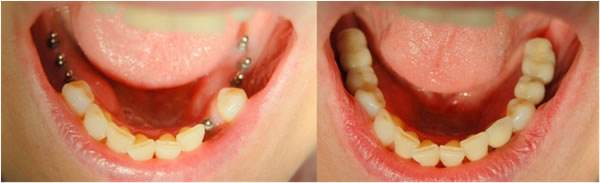 牙齿缺失做种植牙安全性怎么样