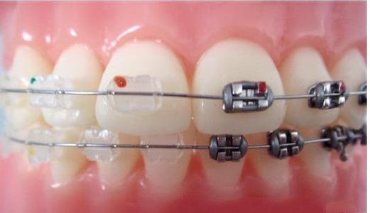 儿童牙齿矫正对牙齿有影响吗
