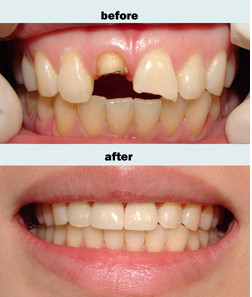 门牙缺损应如何修复？