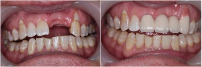 拔牙后多久合适镶牙？