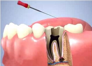 根管治疗后牙齿能用多久