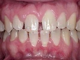 牙齿稀疏导致有哪些危害